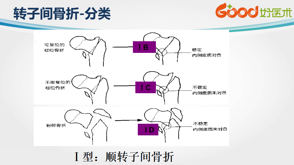 本课件中,周方教授介绍了股骨转子间骨折的定义,分型及诊疗技巧,同时
