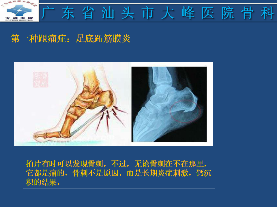 跟痛症的诊治技巧 - 骨科与显微外科专业讨论版 - 医