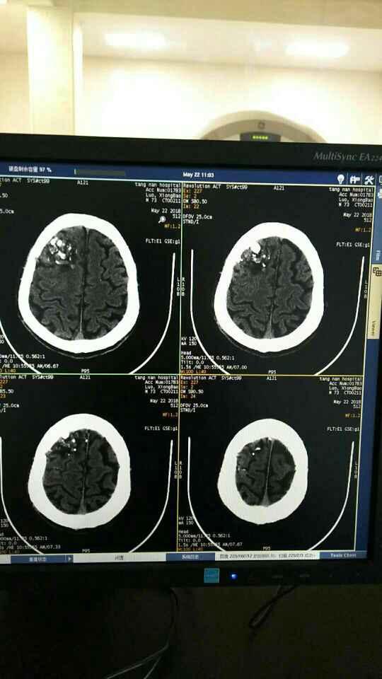 颅脑ct交流