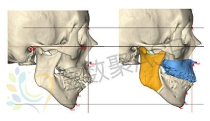 三维可视化技术推动颅颌面外科手术精准化