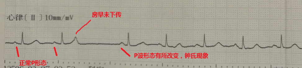 心电图诊断:窦性心律,房性早搏未下传,非时相性房内差传(钟氏现象)