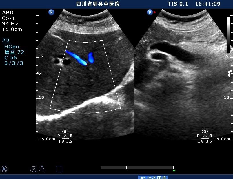 论坛 69 ★临床检查区 69 超声医学讨论版 69 胆总管结石及左肝
