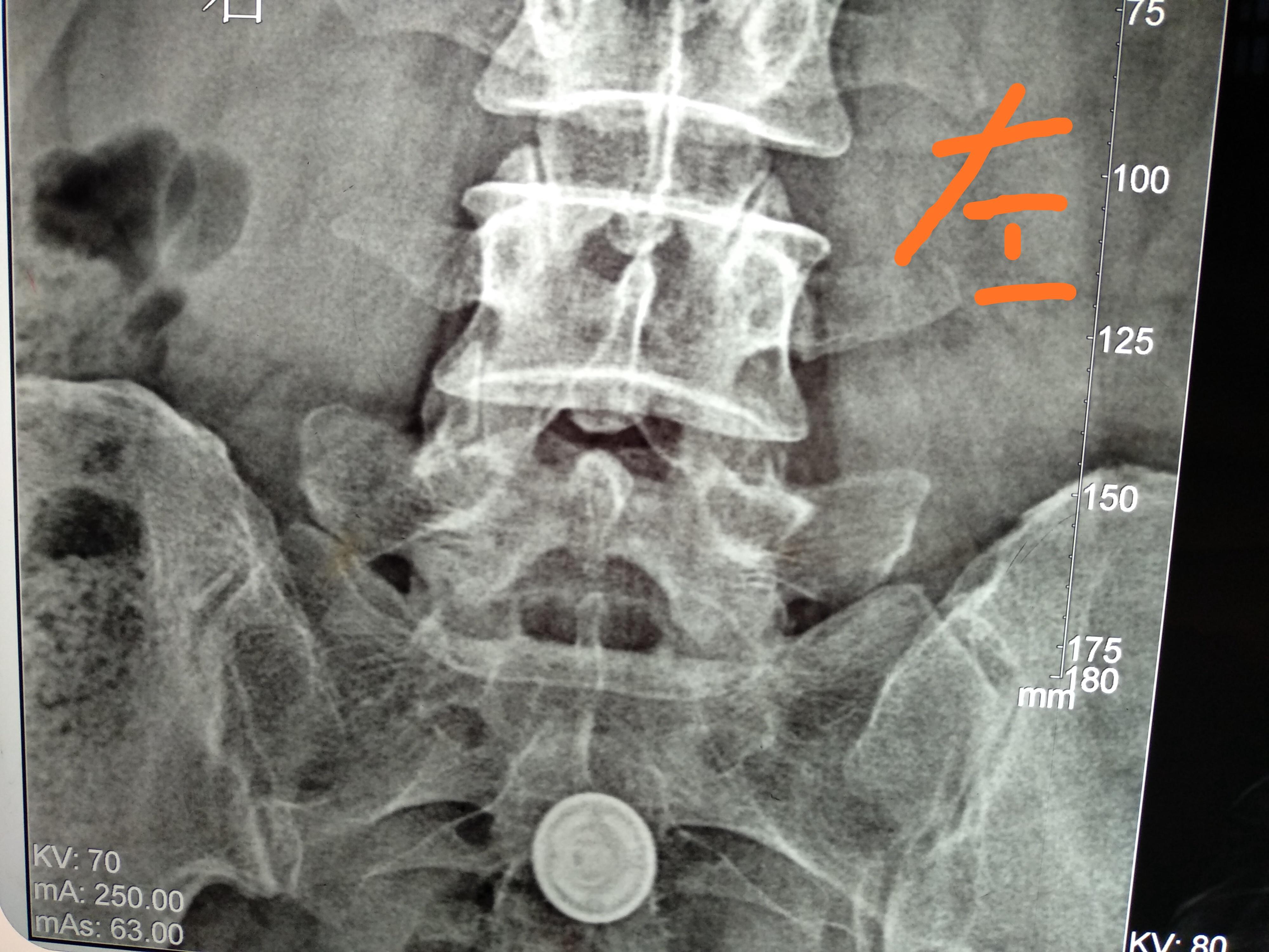 请教下各位老师帮看下这骶髂关节片子