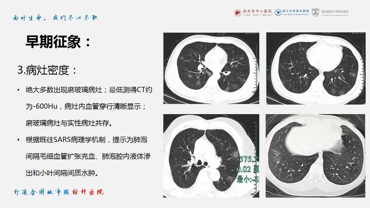 新冠肺炎ct早期征象与临床基础及鉴别诊断