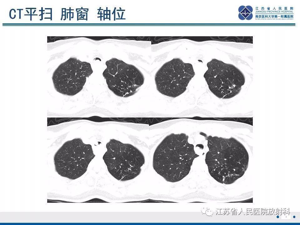 专业资源肺腺样囊性癌