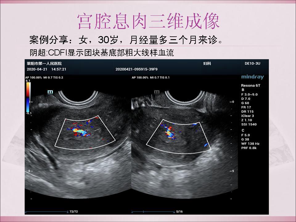 宫腔息肉三维成像 - 超声医学讨论版 - 爱爱医医学论坛