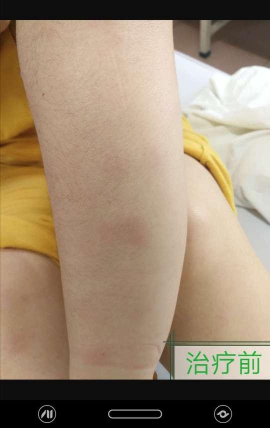 病例讨论:四肢起红斑结节伴疼痛发热 - 皮肤及性传播