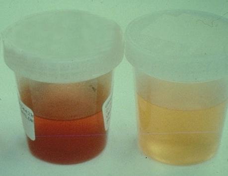 血红蛋白尿呈什么颜色图片