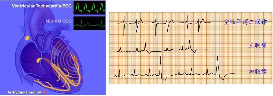 室性早搏的心电活动和图纸,是不是可以,版主给小弟加分喔
