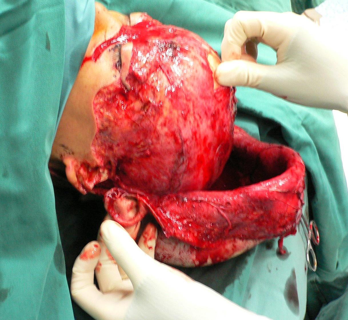 时不慎头发被机器绞卷致头皮大面积剥脱伤,入院后急诊清创原位回植,术