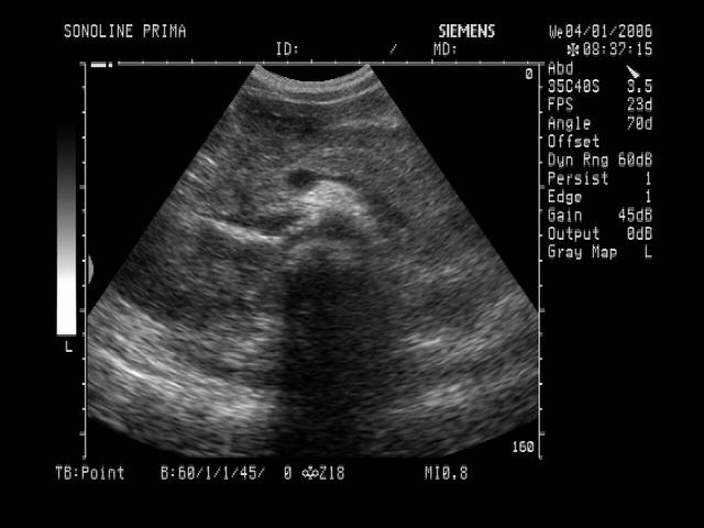 超声显示:肝胆脾未见明显异常,胰头胰尾肿大,胰管回声增强.