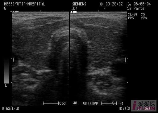 【讨论】甲减也能表现为"火海征"