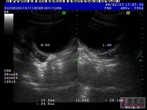 妇科b超:始基子宫 - 超声医学讨论版 - 爱爱医医学论坛 - 爱爱医医学