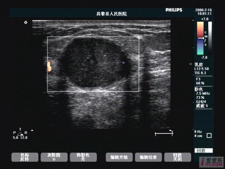 黑色纤维瘤的症状图片图片