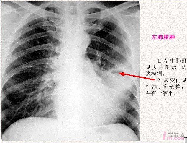 【分享】胸部影像学 [ 三] 肺脓肿