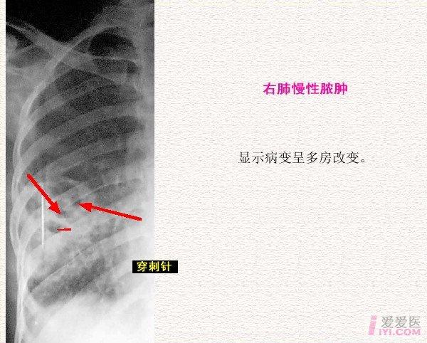 【分享】胸部影像学 [ 三] 肺脓肿
