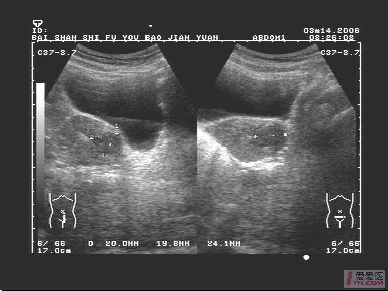 超声显示子宫肌瘤1例