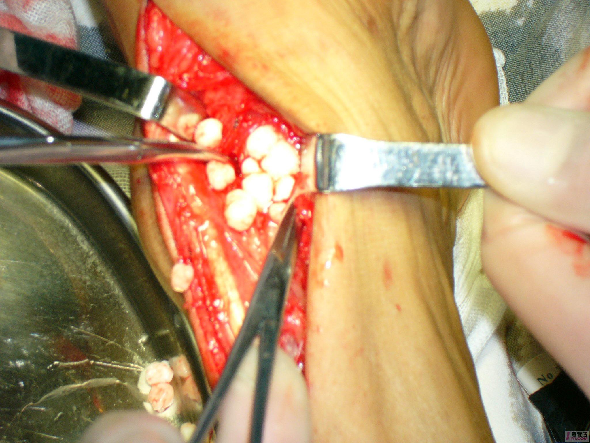 【原创】踝关节骨软骨瘤病