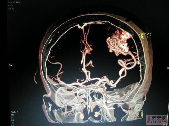 脑动静脉畸形哪种方法治较好(西门子64层ct三维图)