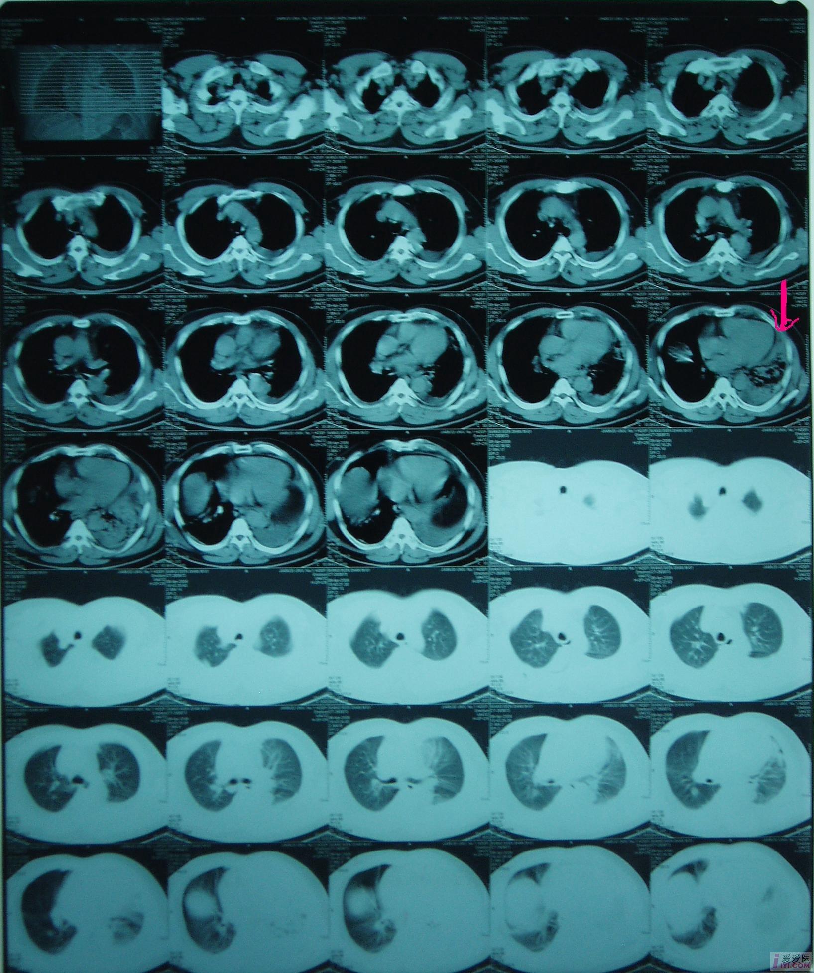 病房患者病例讨论系列(好的讨论会有加分的哦!