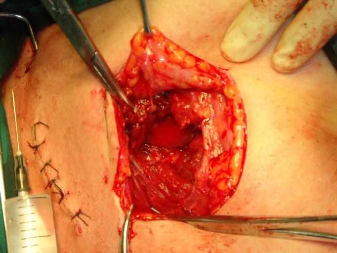 【分享】少见的胸大肌闭合断裂