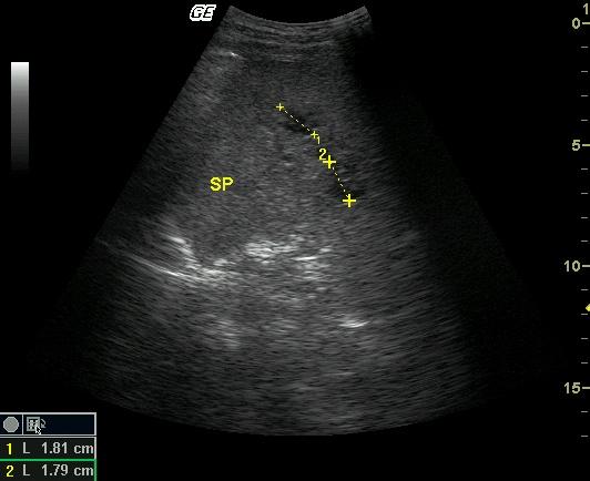 脾静脉超声图图片