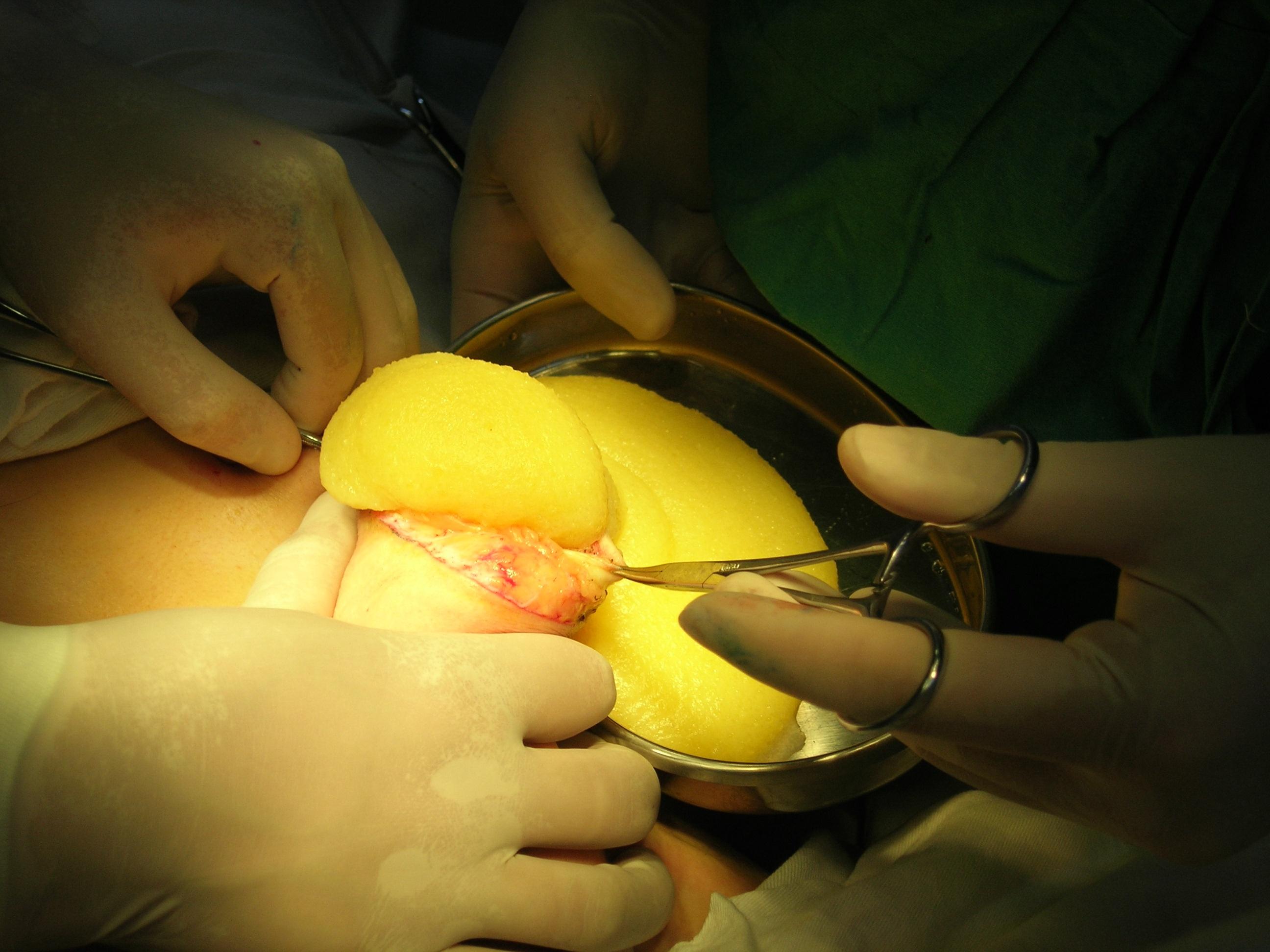 形态不良及硬结,术中取乳晕切口,取出材料后即时植入假体