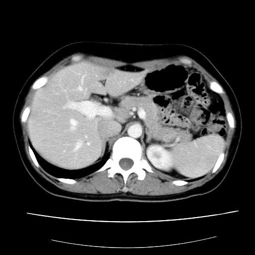 【原创】肝脏小结节,请高手会诊