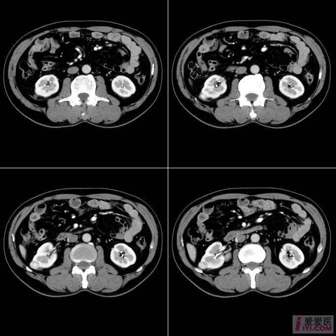 【讀片】右腎病變ct(有病理結果)