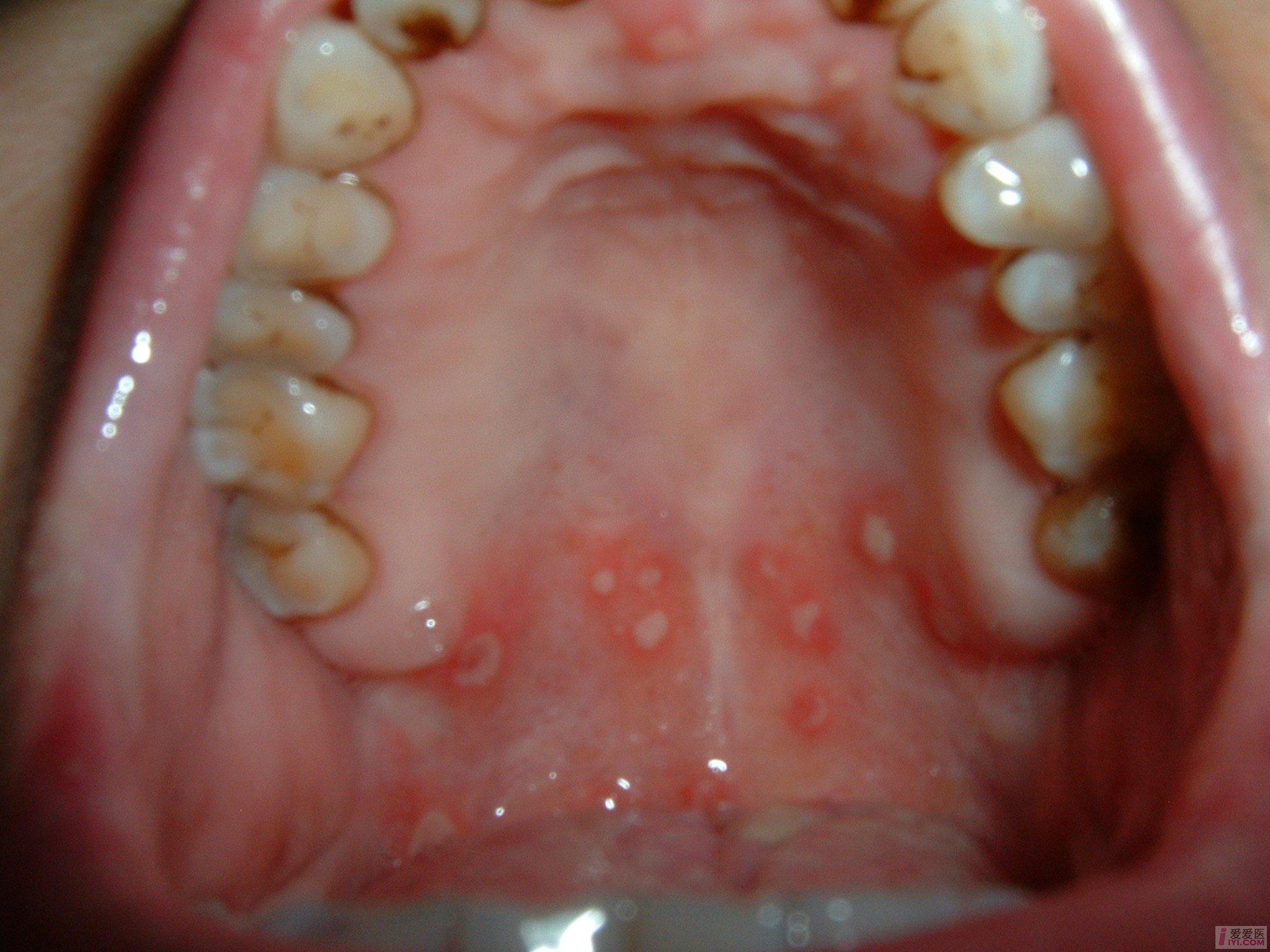 口腔恶性溃疡图片