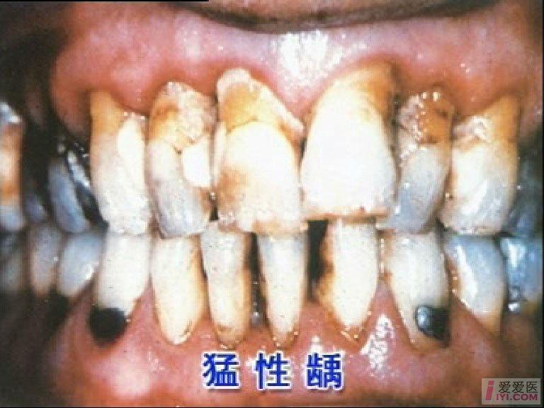 干燥综合症猖獗齿图片图片