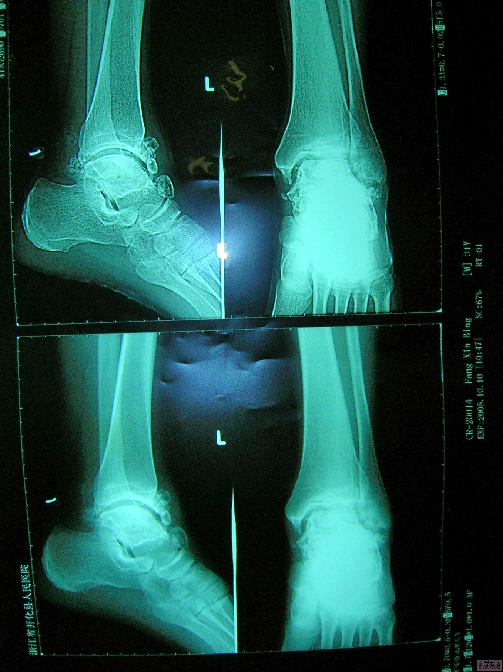 【讨论】踝关节滑膜软骨瘤病x线片