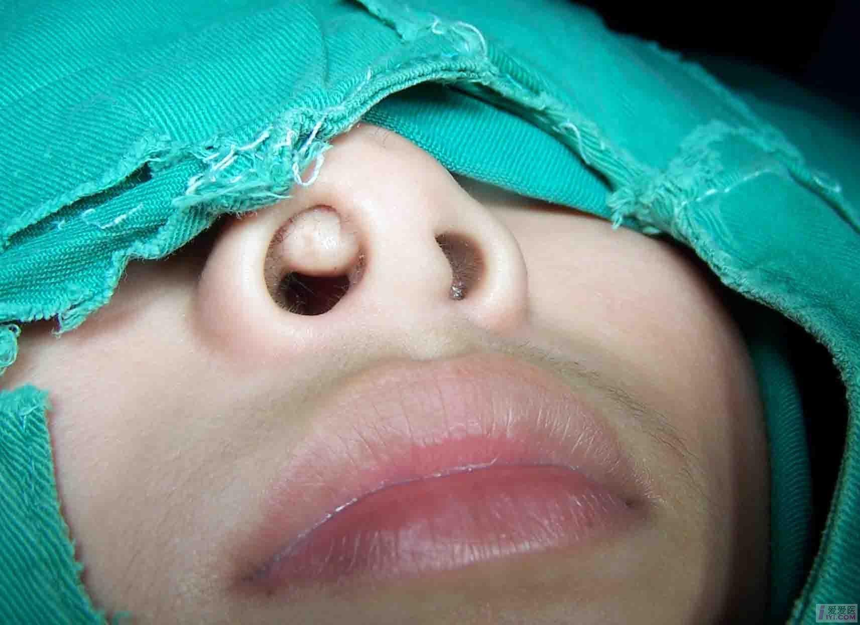 鼻前庭囊肿的症状图片图片