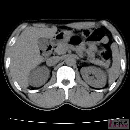 【原创】肾ct片