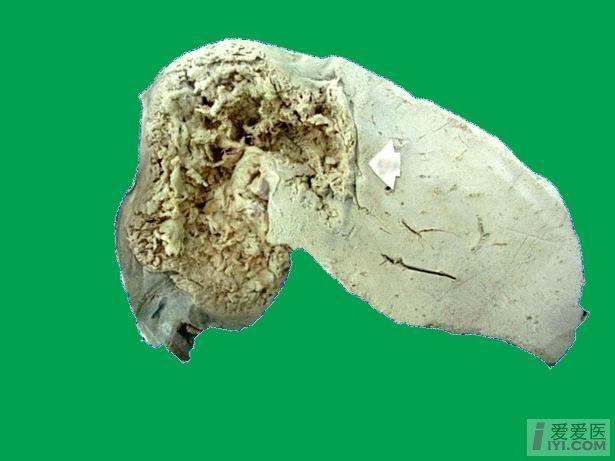 【贴图】典型病理图片