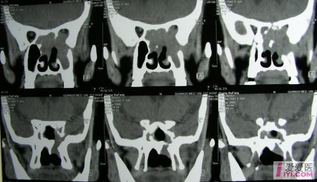 【分享】鼻竇腫瘤ct圖片彙總