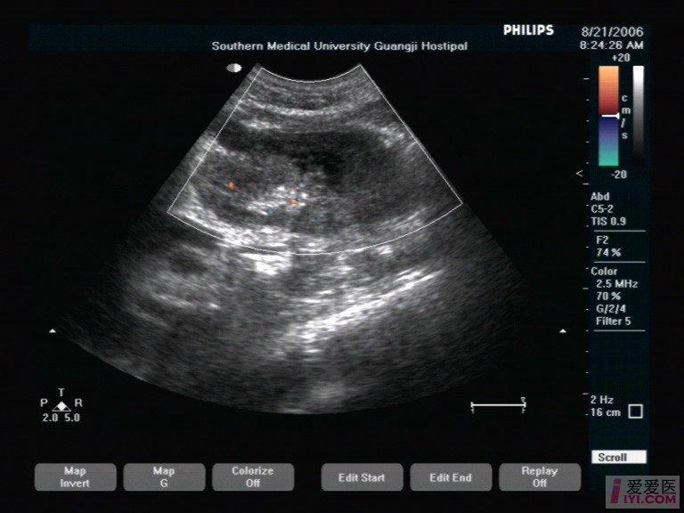 【原创】陈旧性肾挫伤 - 超声医学讨论版 - 爱爱医医学论坛 - 爱爱医