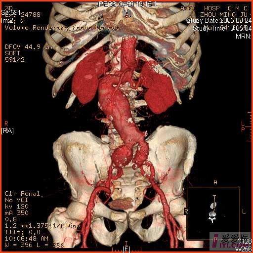 腹主动脉瘤的症状图片