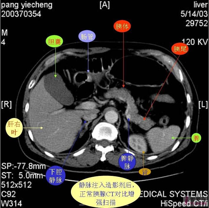 胰腺ct断层解剖图片