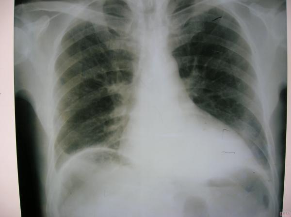 胃穿孔X线照片图片