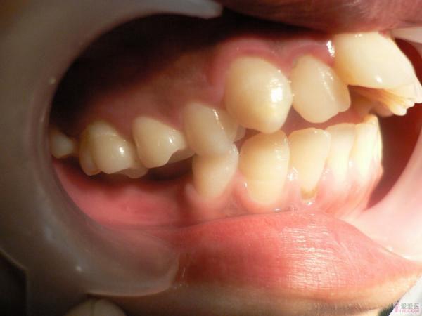 10-09 16:26:56女,22岁下颌发育不足,45缺失,右侧6,7锁合,前牙开合