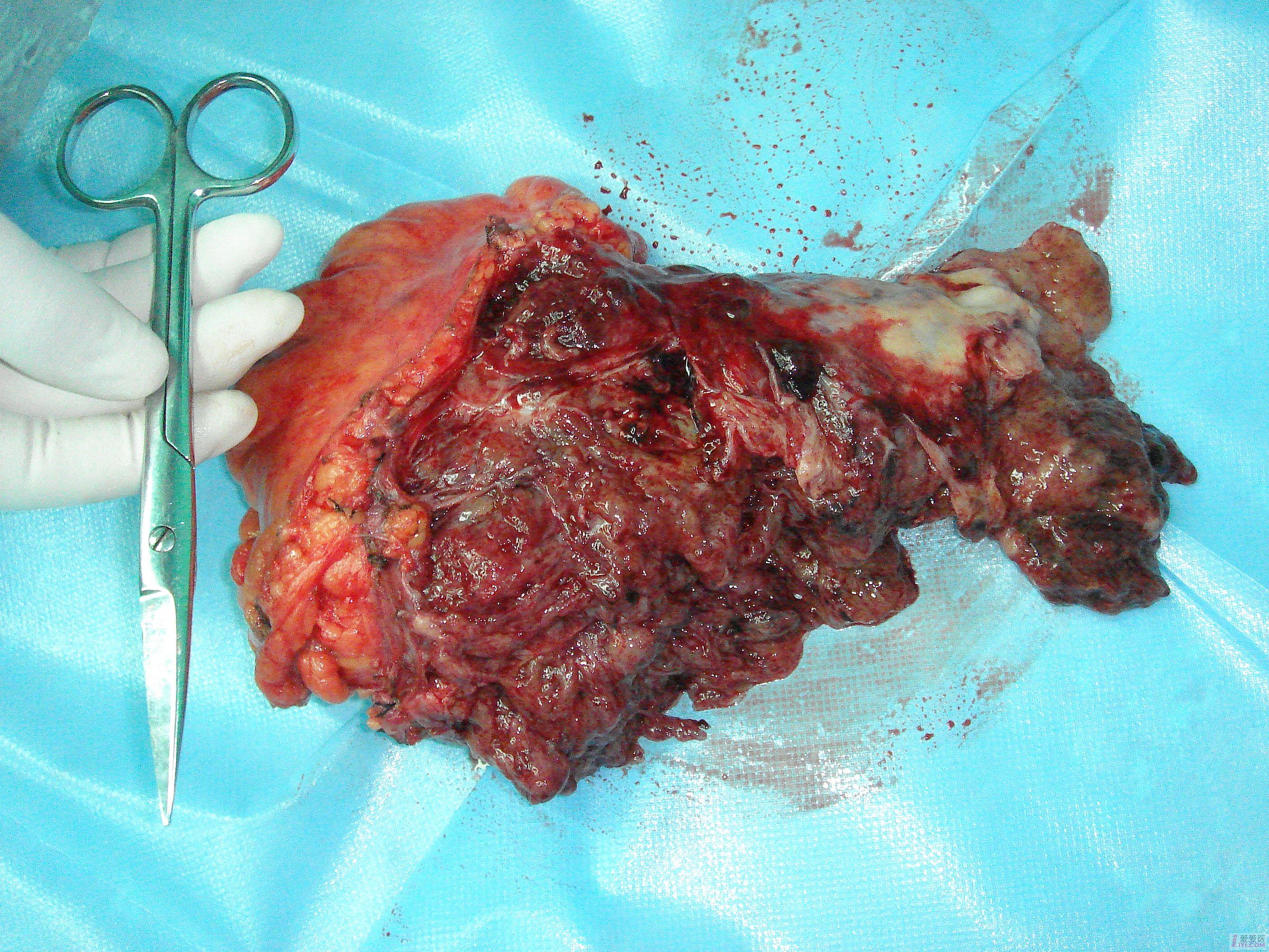 【讨论】盆腔包块,请问诊断是什么?