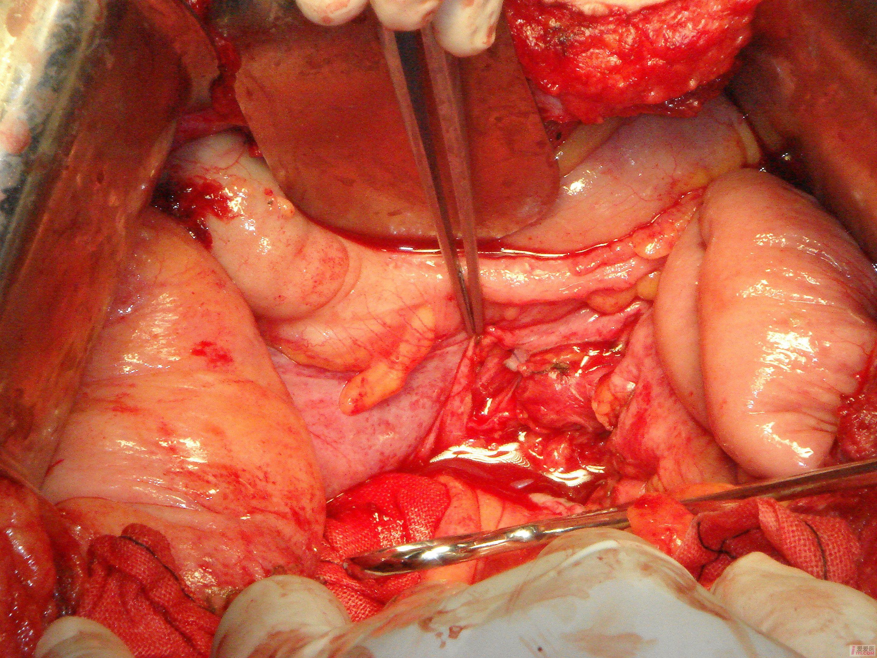 【讨论】盆腔包块,请问诊断是什么?