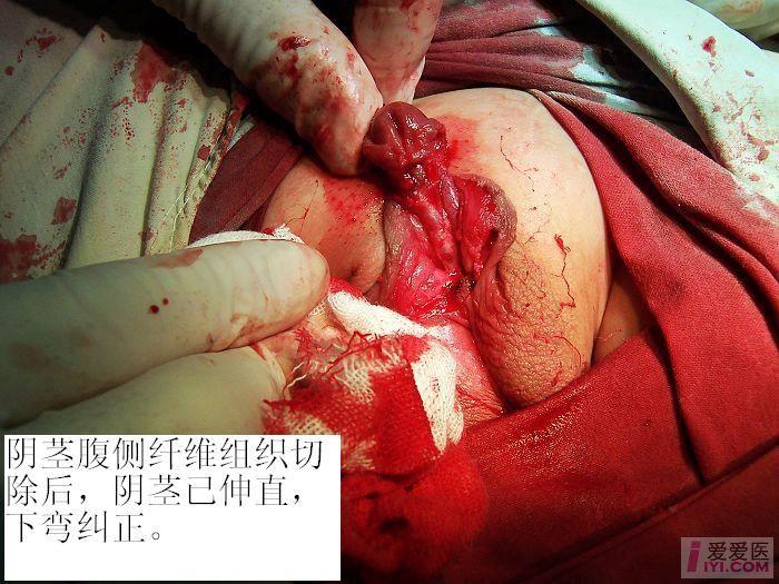 女宝宝尿道下裂手术图片