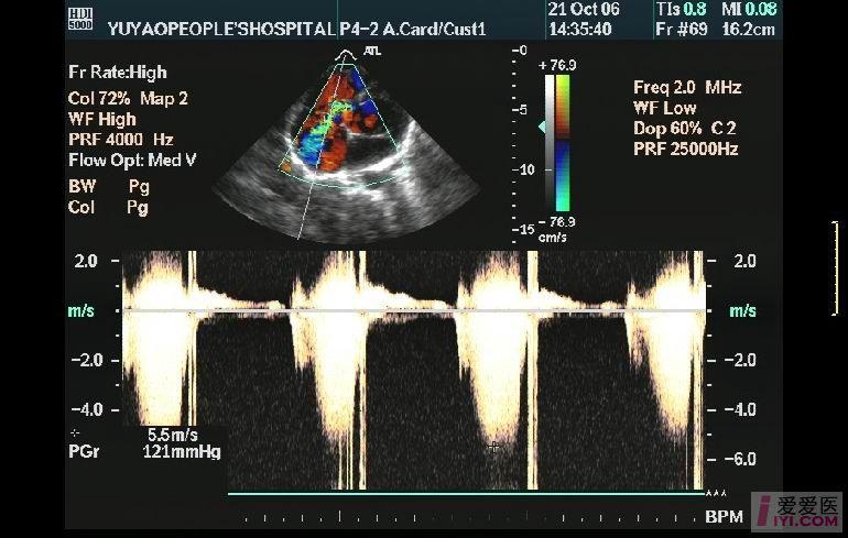 主动脉右冠状窦瘤破裂 - 超声医学讨论版 - 爱爱医医学论坛 - 爱爱医