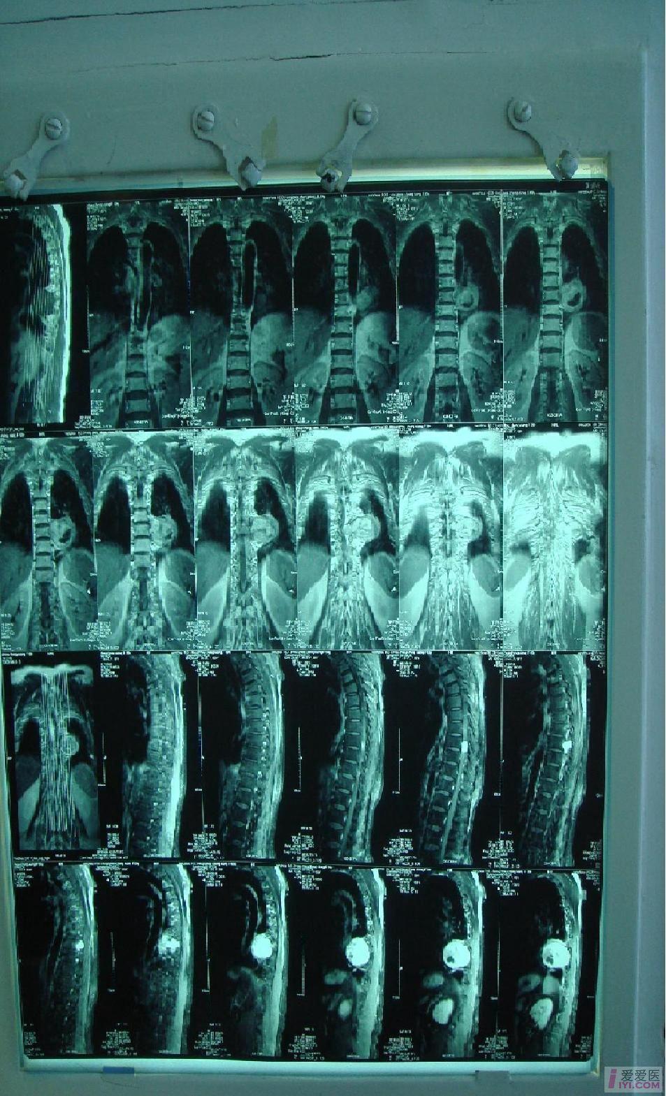 巨大胸椎椎管内占位病变,请求高人指点.