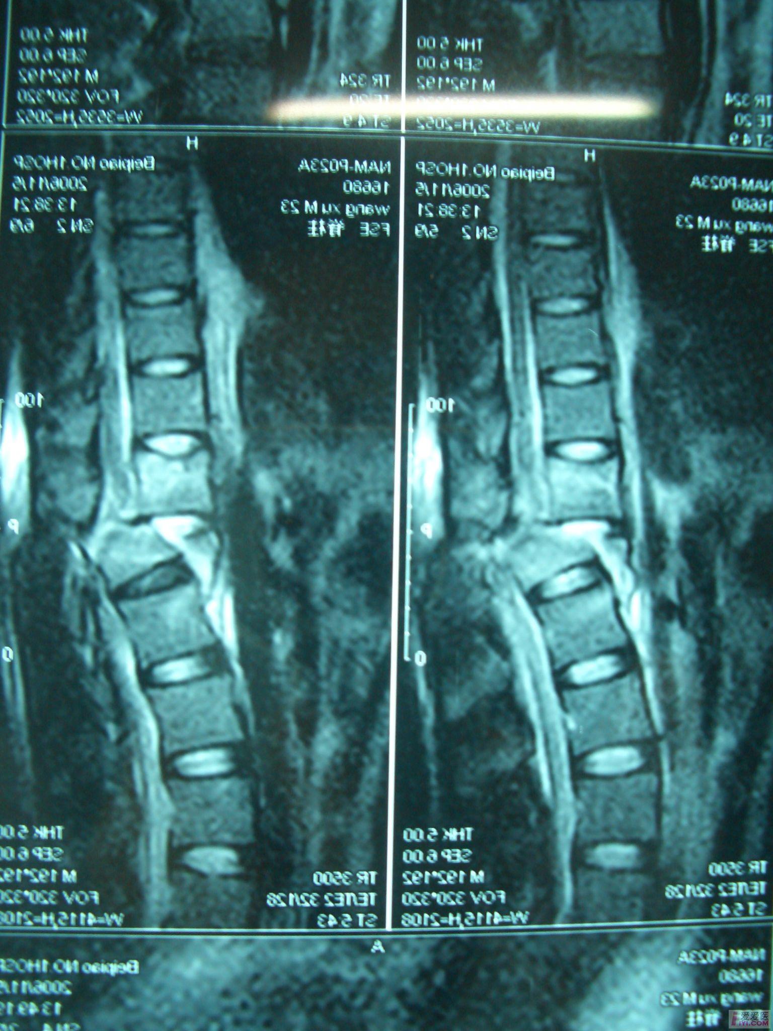 【讨论】t12压缩骨折,脱位伴脊髓损伤,截瘫