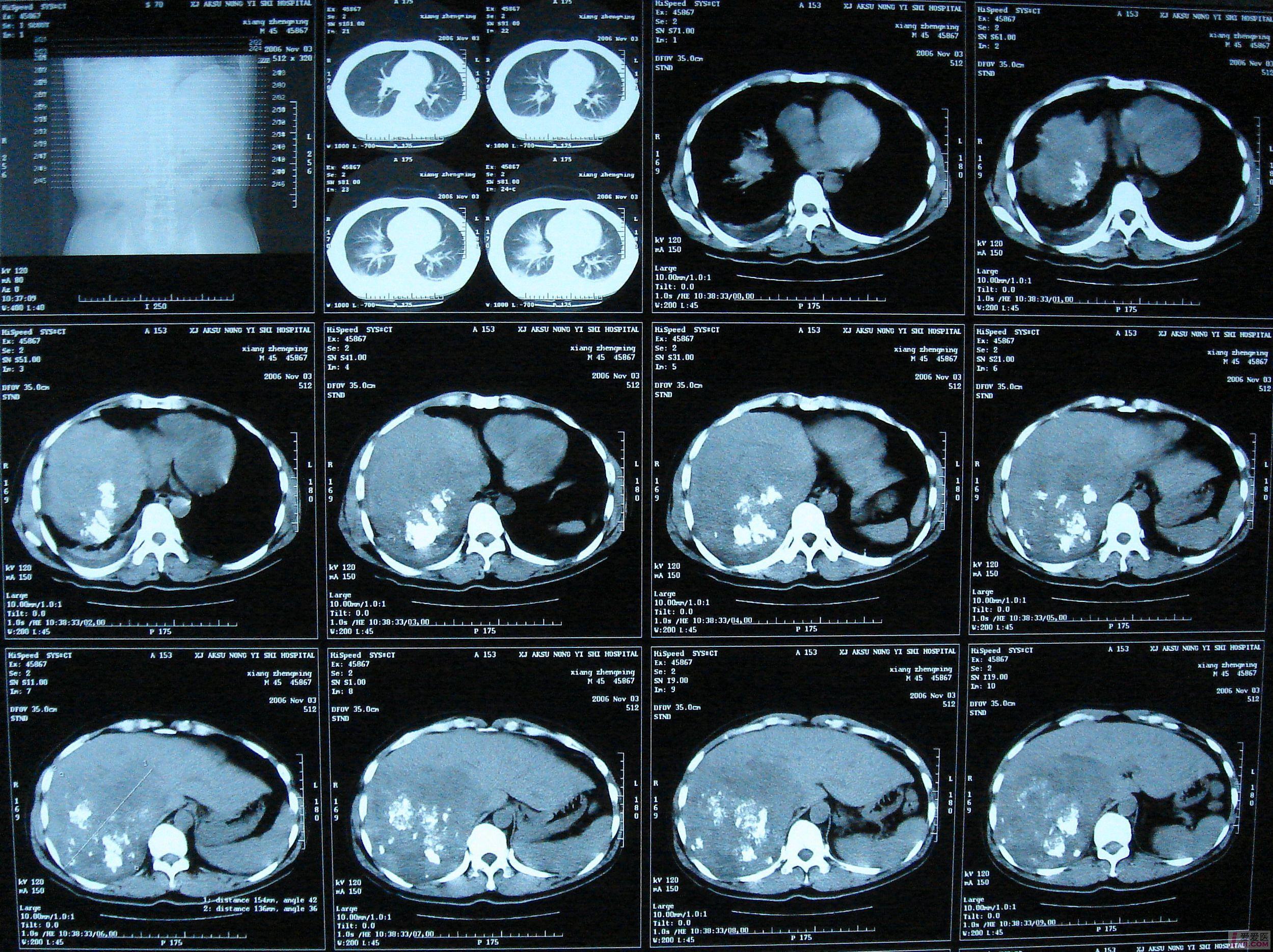 肿瘤片子图片