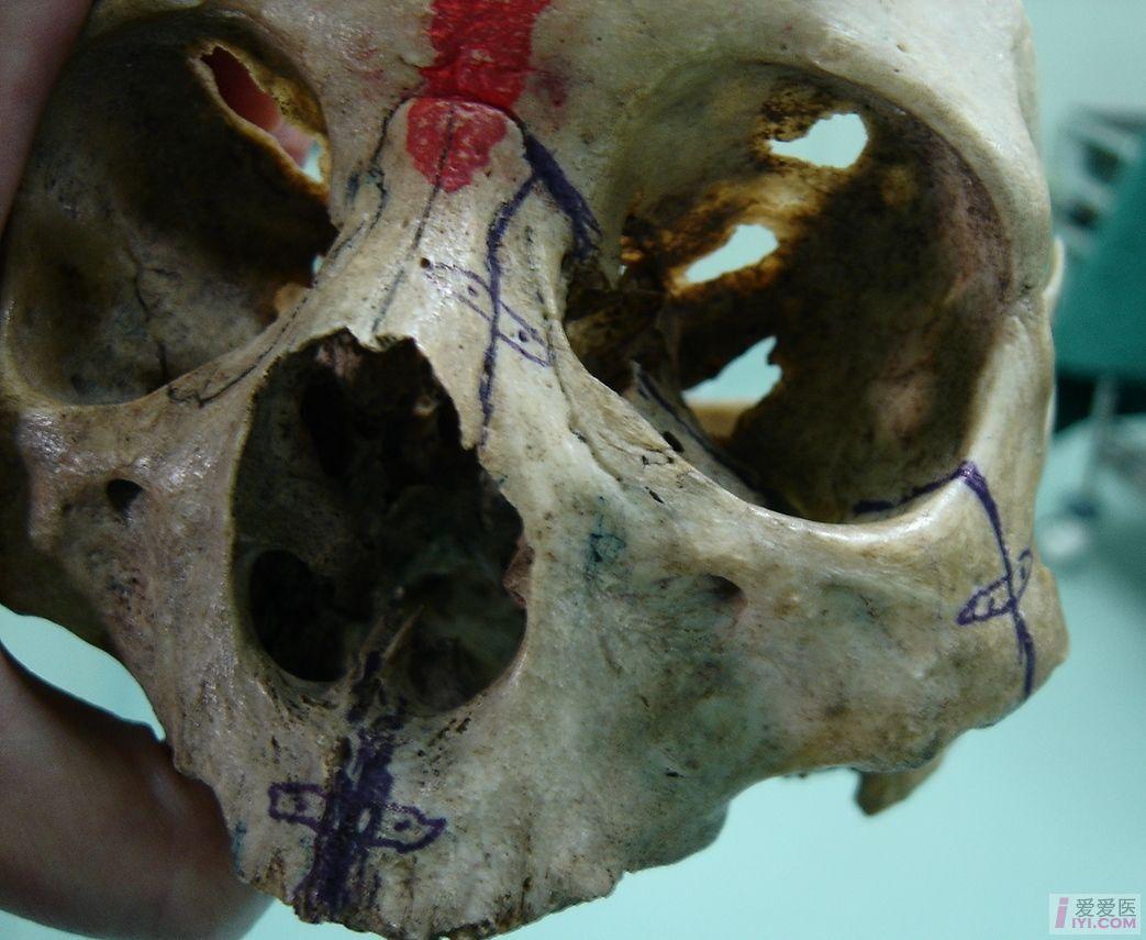 【原创】上颌骨切除及掀翻术骨骼示意图