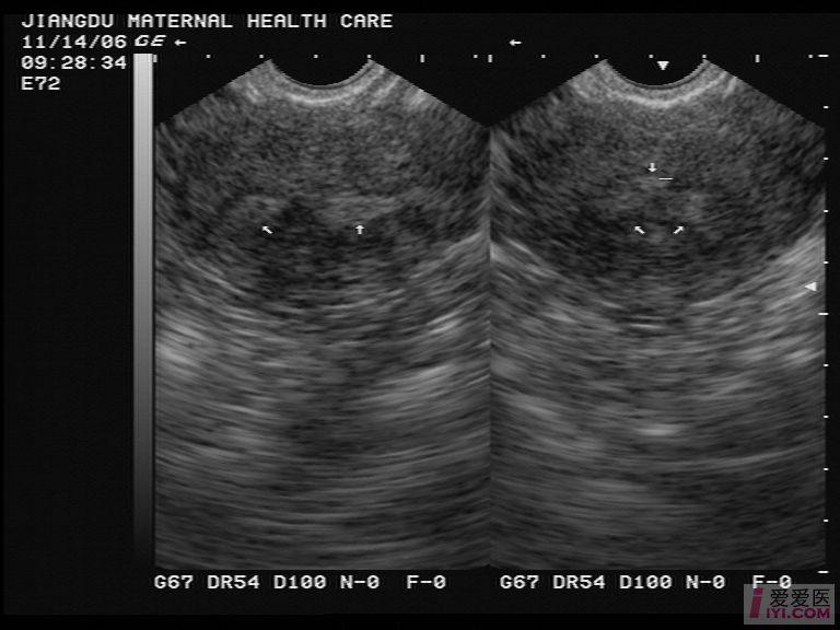 超聲所見:子宮橫徑增大(49*47*60mm),內膜厚6 mm,呈y型分佈.